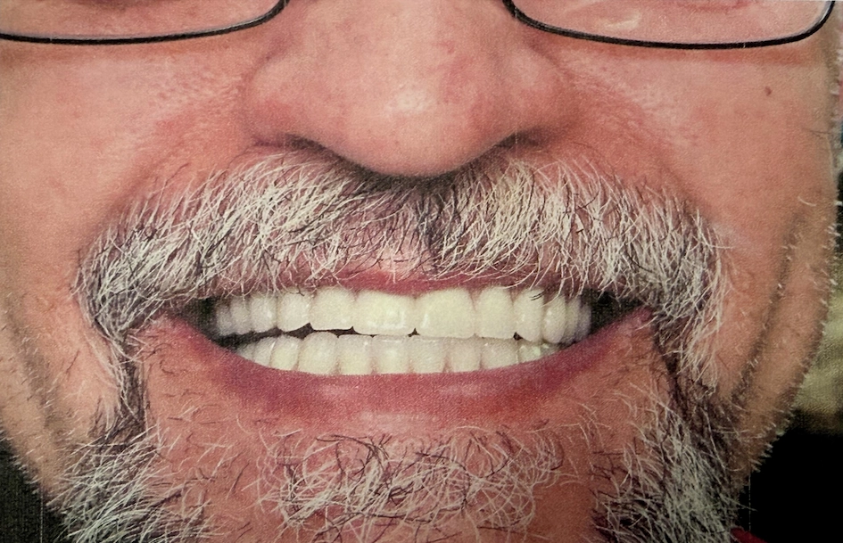 After smile makeover